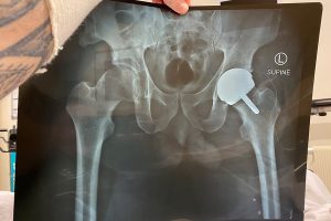 hip replacement 300x200